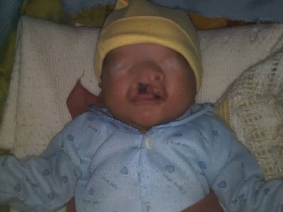 help suffers from cleft lip